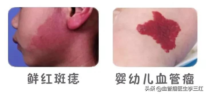 以为是胎记检查是血管瘤要紧吗,有些宝宝有胎记是什么原因造成的