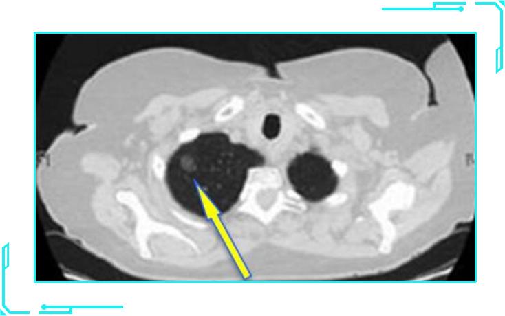 肺结节7mm需要做肺癌抗体7项,肺结节高危与早期肺癌的区别