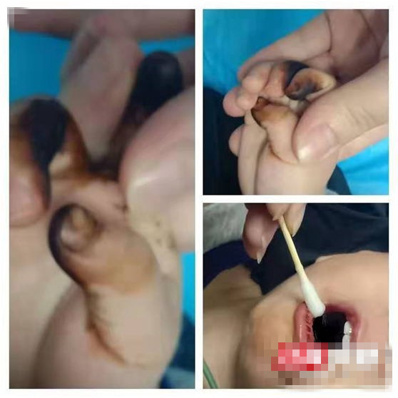 高锰酸钾儿童误食的后果,高锰酸钾孩子误食了咋办