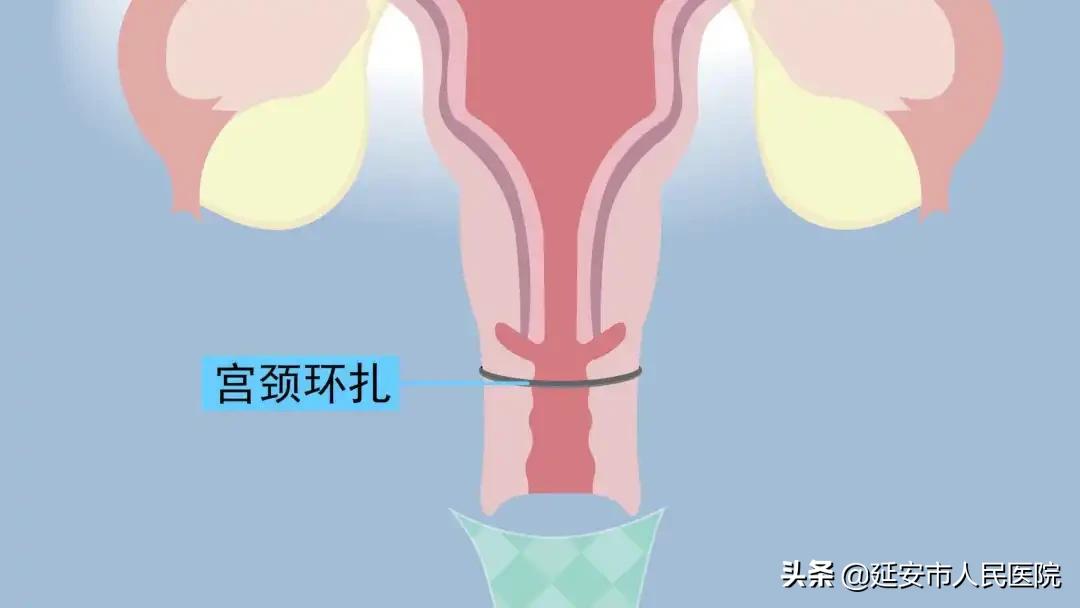 宫颈机能不全患者的福音丨宫颈环扎术