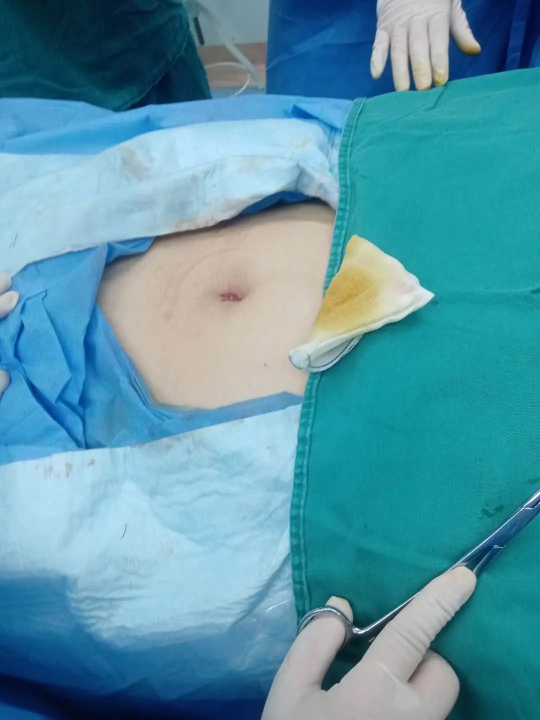 另辟“脐”径让伤痕隐形----我院妇产诊疗中心成功开展第一例单孔腹腔镜手术