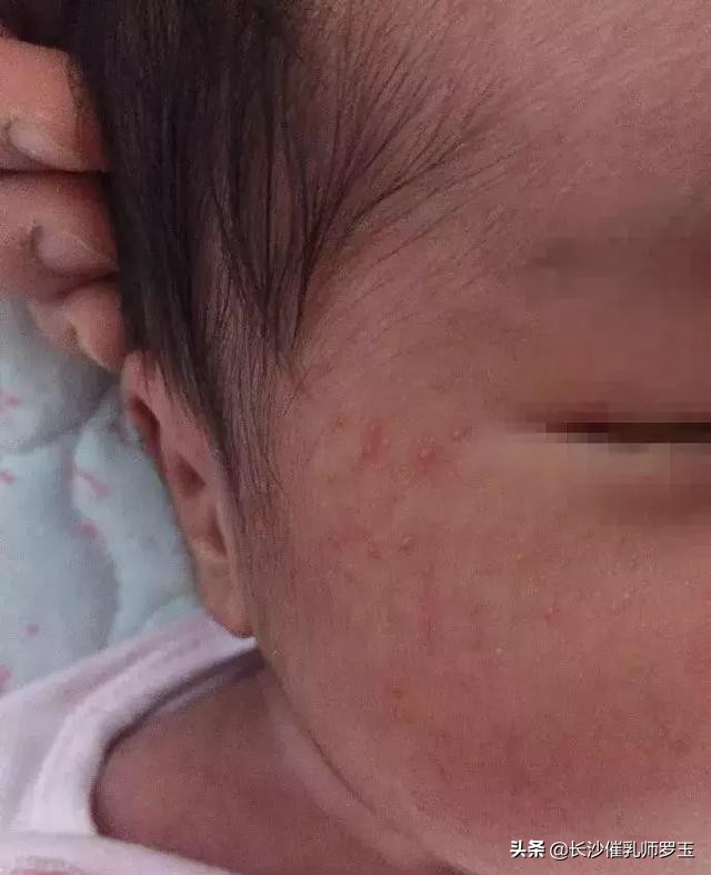 宝宝低烧过后身上起小红点,40天宝宝身上起小红点