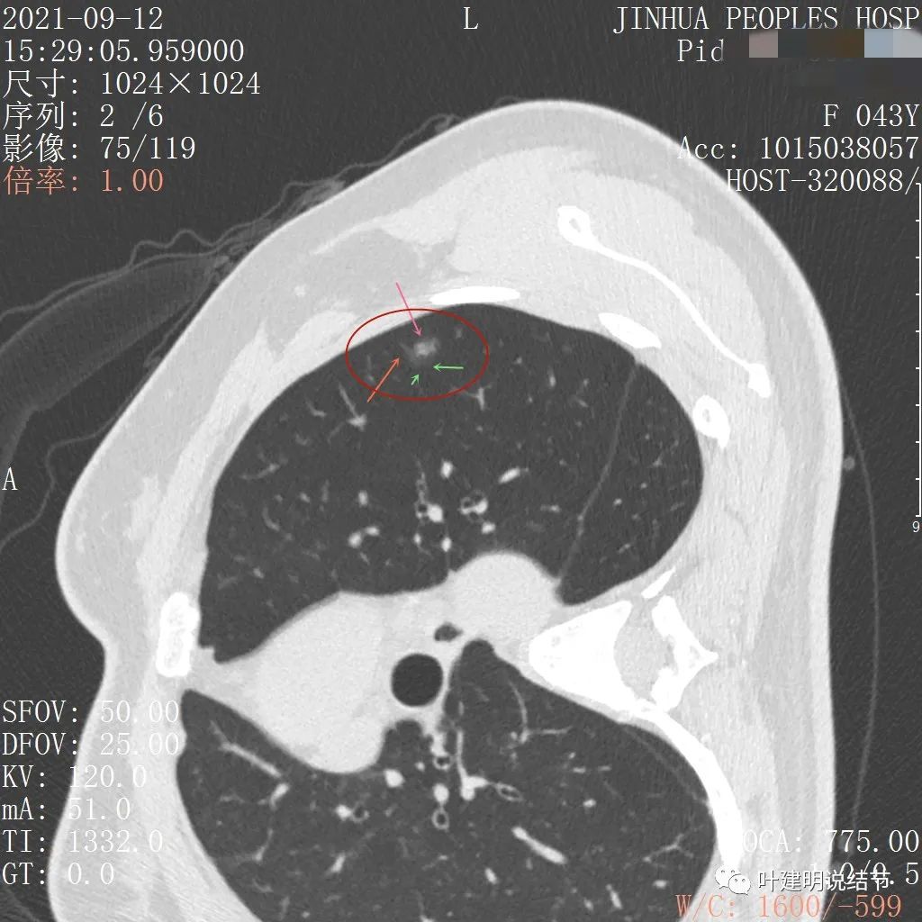 怎样从病理报告看是不是原位癌,原位腺癌切除子宫要开刀吗