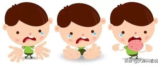 手足口病高发期快来看看怎样预防,手足口病进入高发期家长一定注意