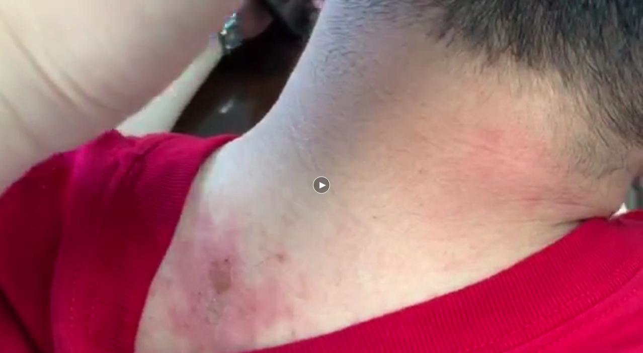 隐翅虫皮炎恶化过程图,隐翅虫不咬人人们患隐翅虫皮炎