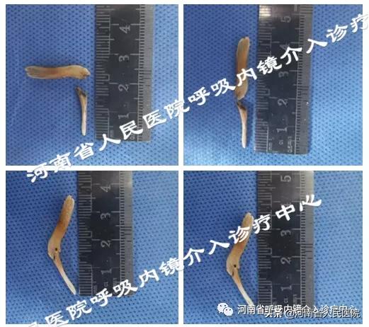 一年前吃的甲鱼骨，竟在气管里成了要命的“回旋镖”