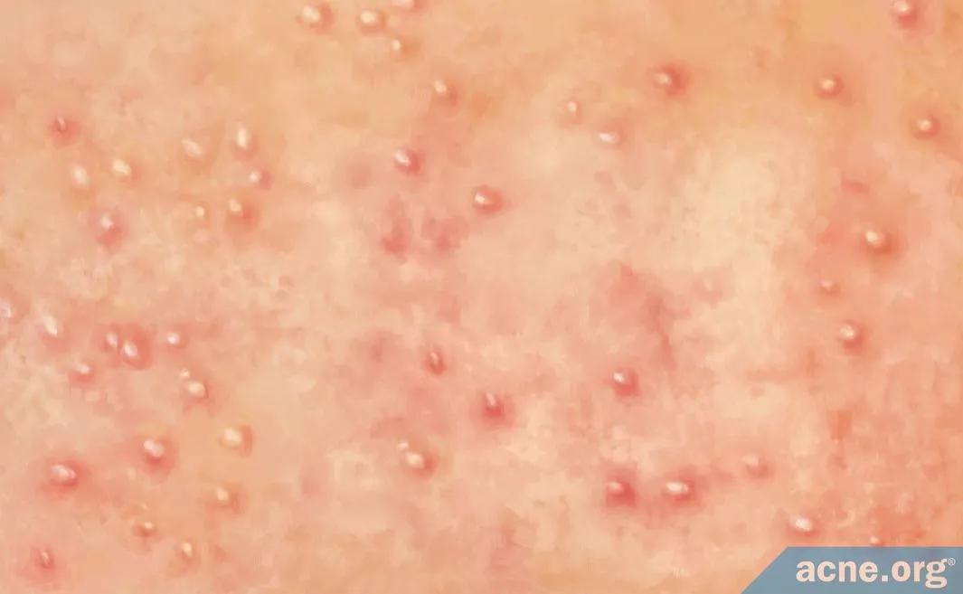 毛周角化症和鸡皮肤的区别,毛周角化病和鸡皮肤有什么区别