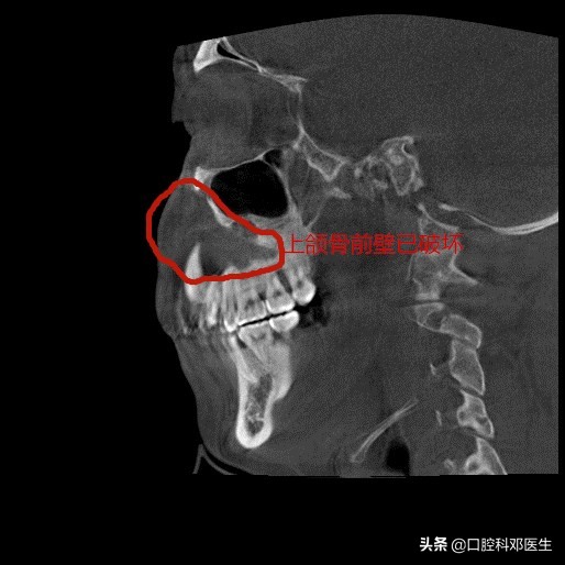 上颌左边埋伏阻生牙的拔除视频,埋伏阻生牙拔除会得干槽症吗