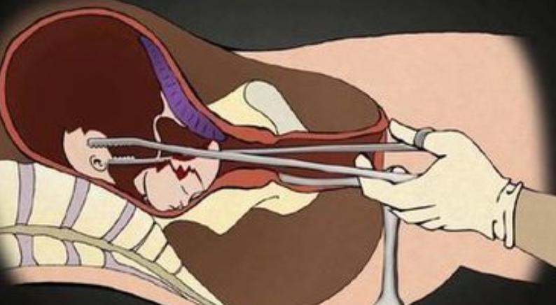 流产出来的胎儿怎么处理才最合理,被流产的胎儿都去哪里了