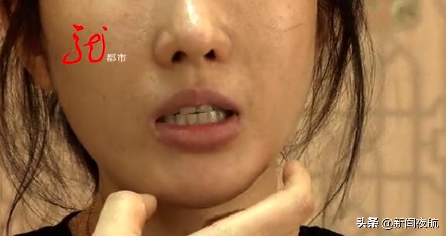 打了十三针瘦脸针脸斜了,女子打完瘦脸针发现瘦过头