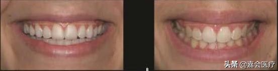 怎么不露齿笑才自然好看,如何笑不露齿笑起来好看的技巧