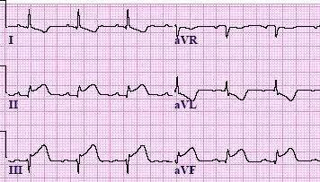 常见心梗特殊心电图,各部位心梗心电图详解