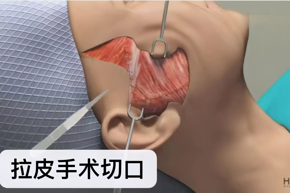 拉皮手术面部表情,拉皮手术会损失面部表情吗