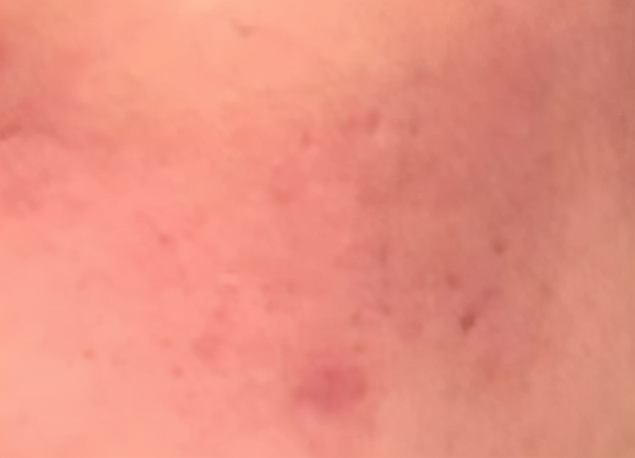 有创激光疤痕修复,脉冲激光治疗后怎么护理