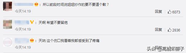 阿娇额头伤口恢复过程,阿娇晒伤口恢复照