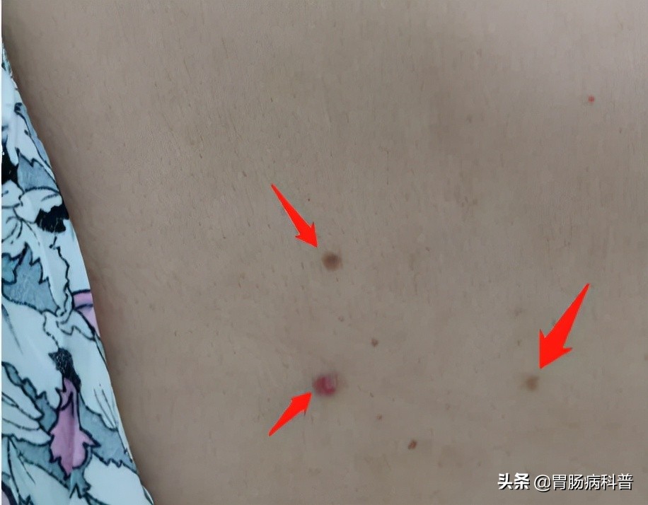 70岁老太，长出粗黑腿毛，医生说，这可能是癌的征兆