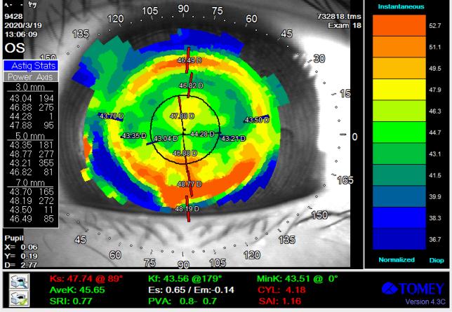 角膜散光大者一定不能配戴角膜塑形镜么？