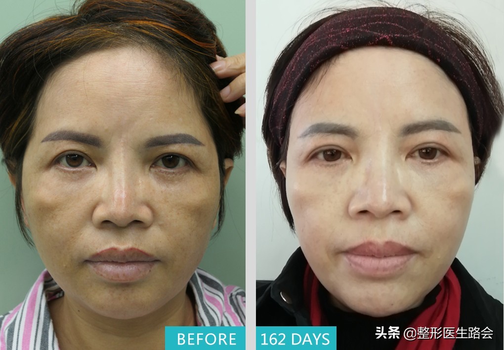 太阳穴凹陷颧骨高适合留中分吗,太阳穴凹颧骨高用什么哑光高光好