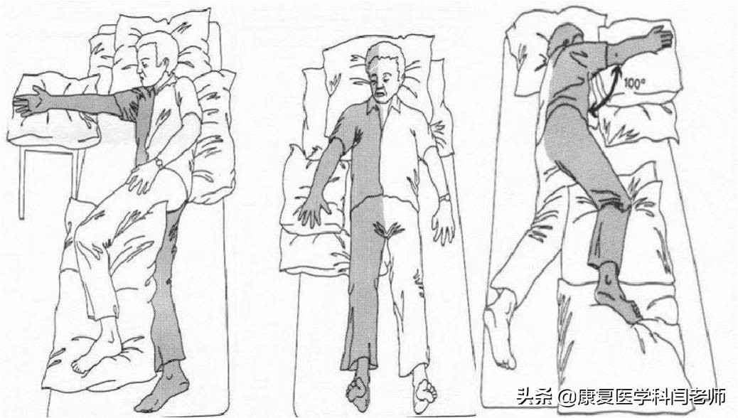 脑卒中后偏瘫患者常见并发症:肩手综合征的康复治疗