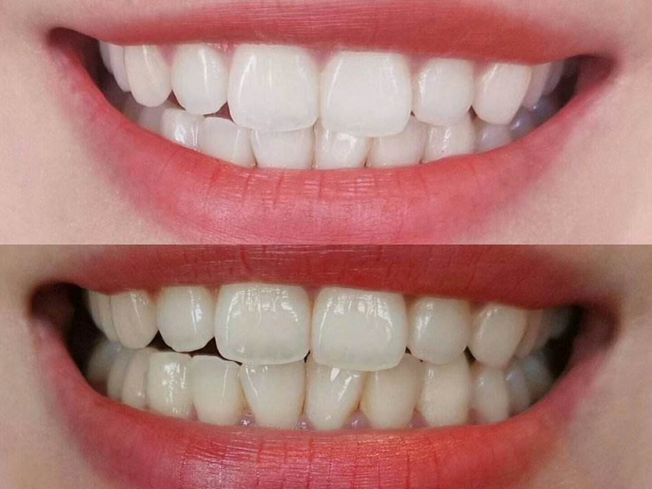 刘涛是全口瓷牙,演员刘涛的一口烤瓷牙多少钱