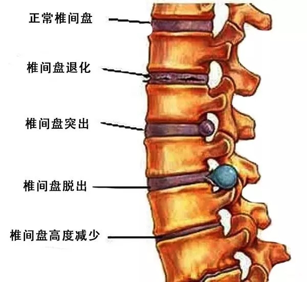 腰突腰痛怎么办最快缓解,腰突腰痛试试这九个动作