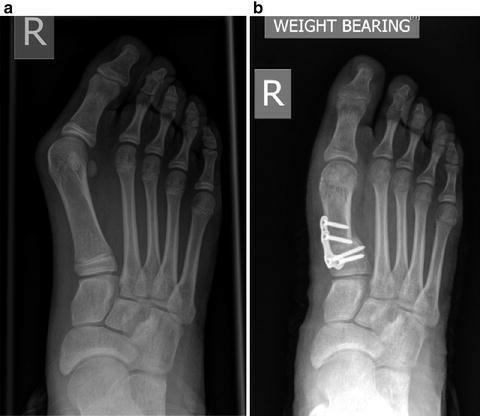 拇外翻大脚趾疼如何在家就能治,大脚拇指痛要警惕