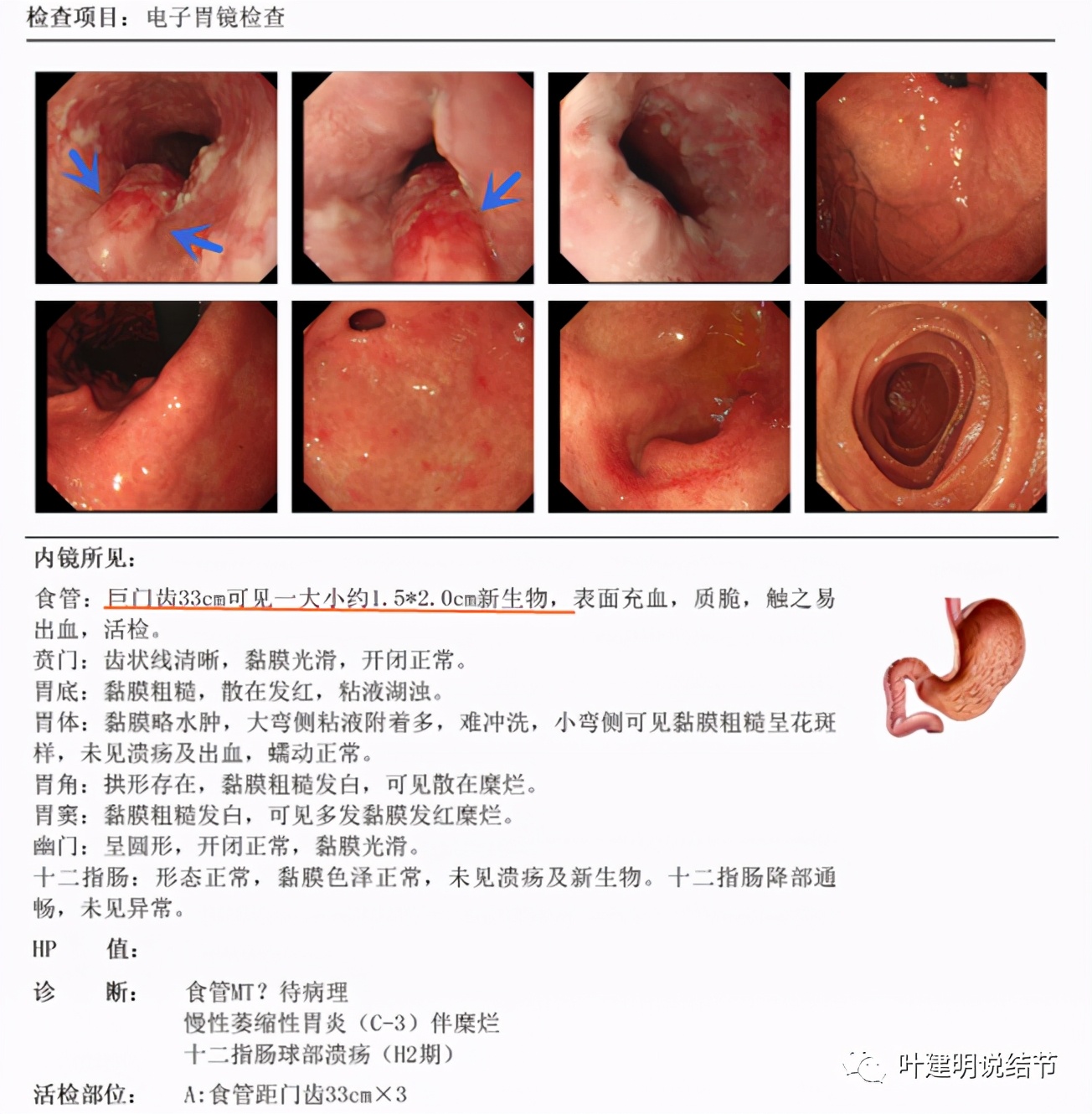 同时患结肠癌和直肠癌怎么办,同时查出了胃癌和肺癌怎么办