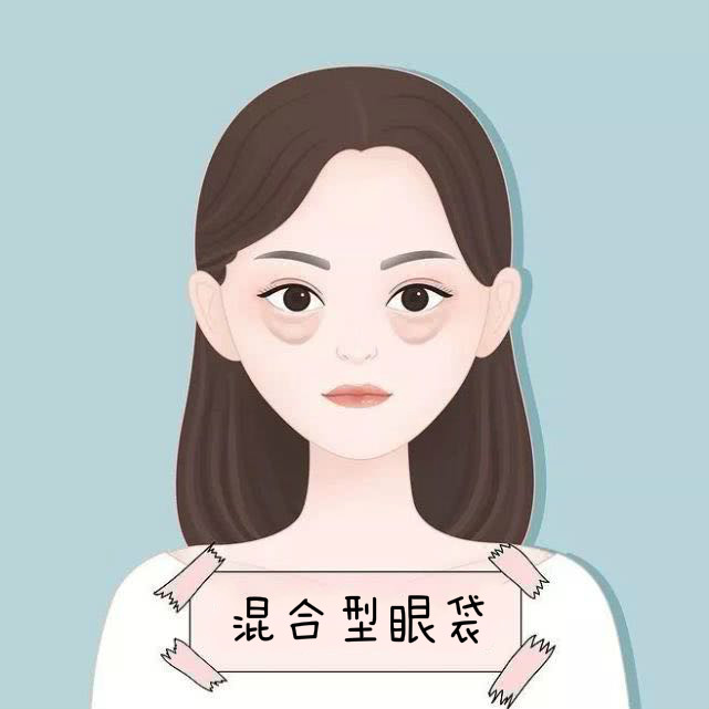 别让眼袋泪沟耽误你的美丽,不要让眼袋影响了你的颜值