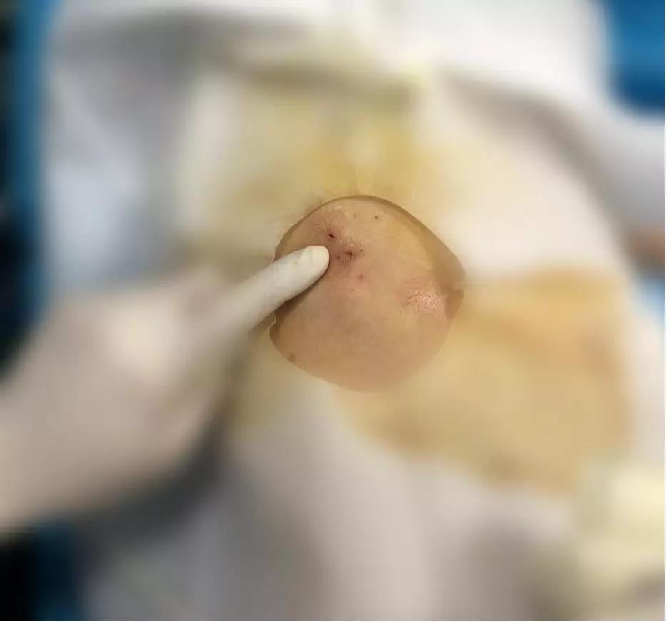 陕西中医药大学超声医学,射频消融术对肝癌治疗的疗效