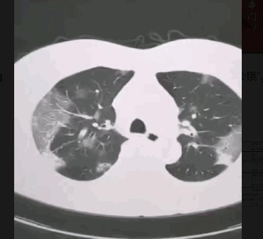 新型冠状病毒肺炎ct影像学特征,新型冠状病毒肺炎的认知与防控