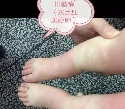 孩子高烧五天不退严重后果,孩子夜里发热不能及时就医严重吗