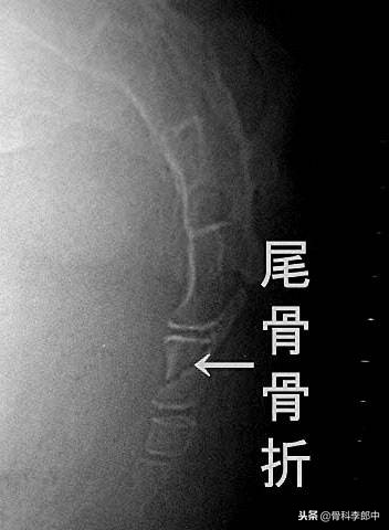 屁股蹲地上了尾骨很痛咋办,一个屁股蹲造成腰椎骨折