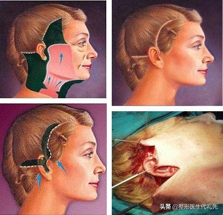 咨询医生怎样去除皱纹,医生讲颈纹怎么消除的小妙招