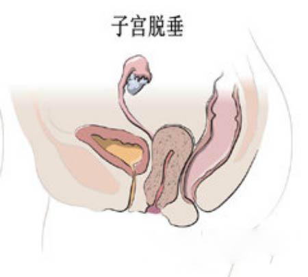 大妈跳广场舞掉水里,女子跳广场舞感觉体内有东西掉落