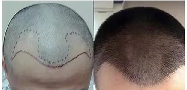 非遗传性雄性脱发能治好吗,遗传性脱发植发后还会掉吗