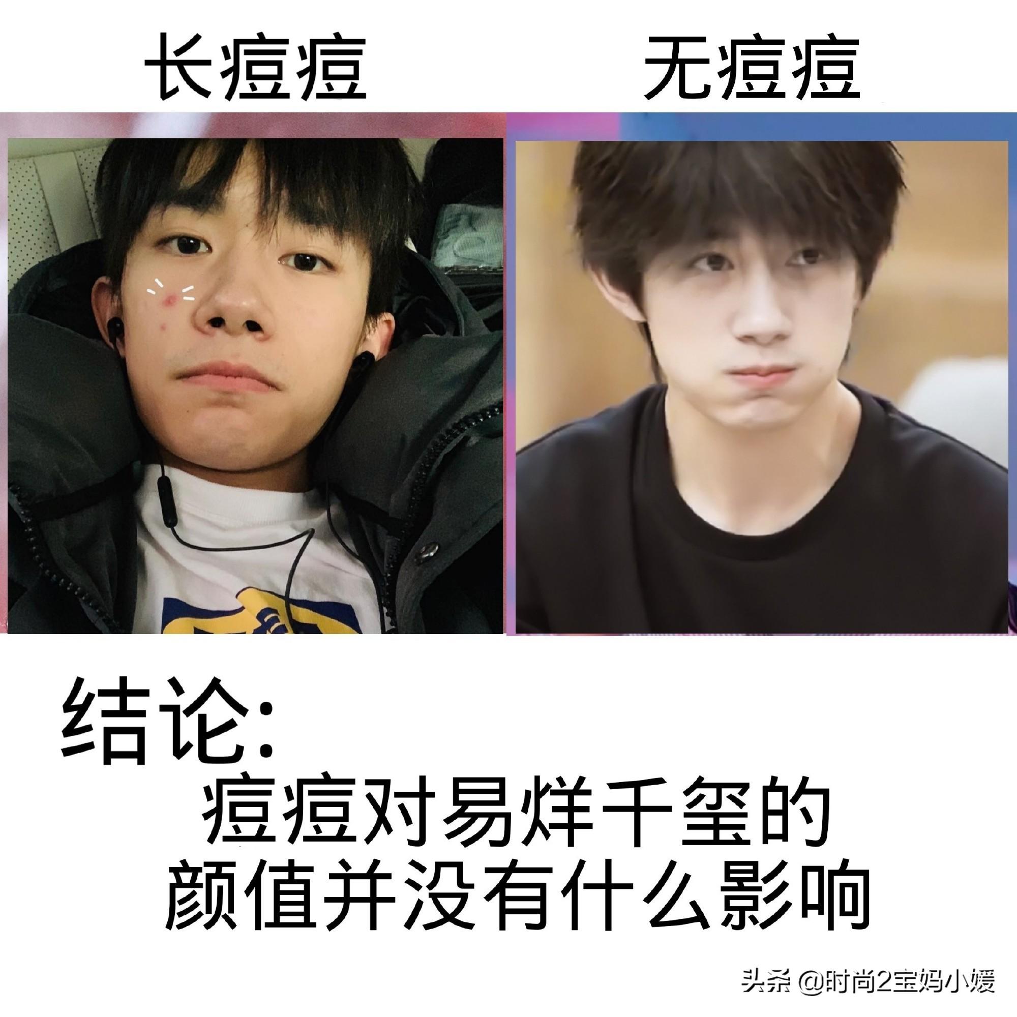 长痘并不可怕拯救痘痘肌,长痘痘了不要怕教你轻松一招解决