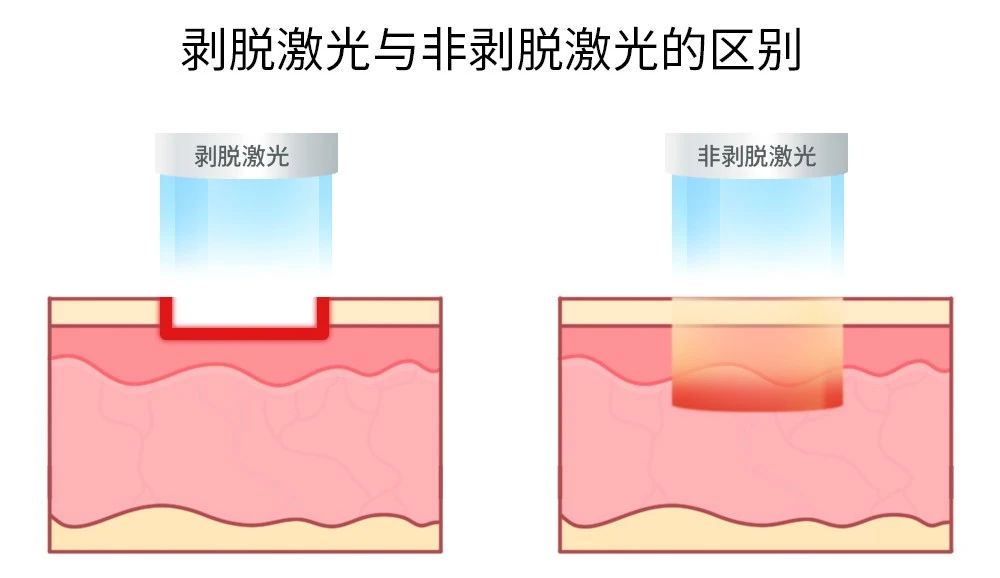 沈阳点阵激光除痘坑做得好,痘坑打点阵激光多少岁能做