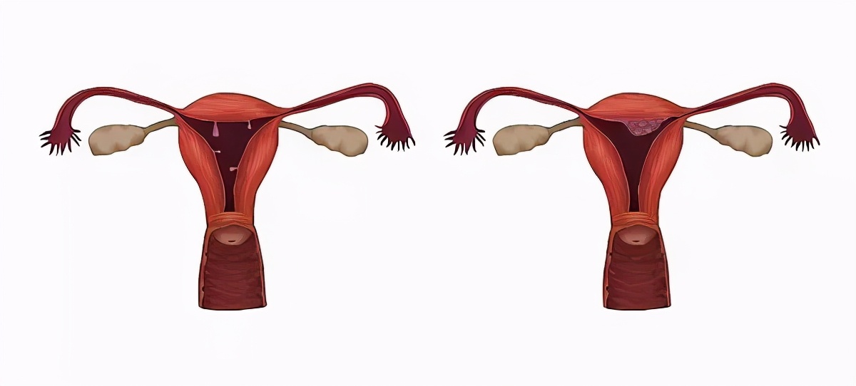 息肉时间长了会是癌吗,胃里0.2-0.4厘米的息肉要不要切