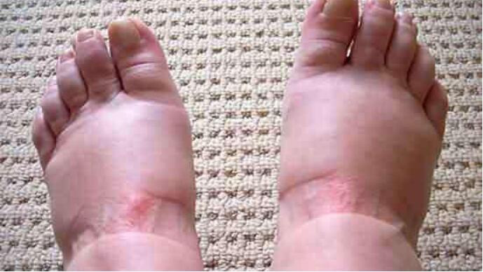 脸部浮肿要少喝水吗,孕期水肿需要去医院吗