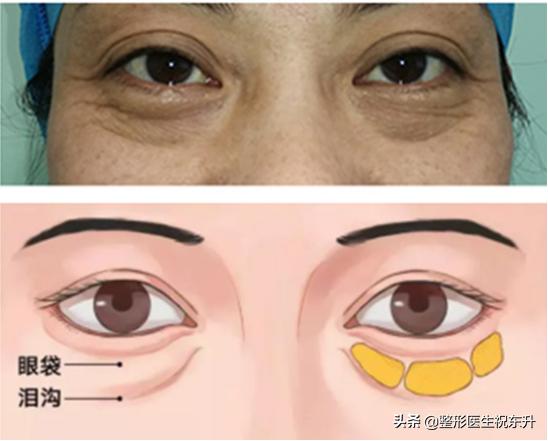 有眼袋、泪沟该怎么办？医生为你支个招