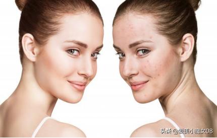 孕妇怎么防止宝宝长斑,孕早期如何避免孩子长斑