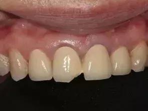 烤瓷牙崩了一块修复方法,烤瓷牙崩瓷了怎么修复