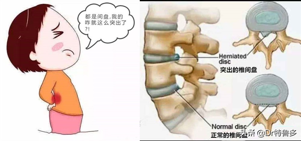 青少年腰痛，小心误诊，也有可能是得了一种“老人病”