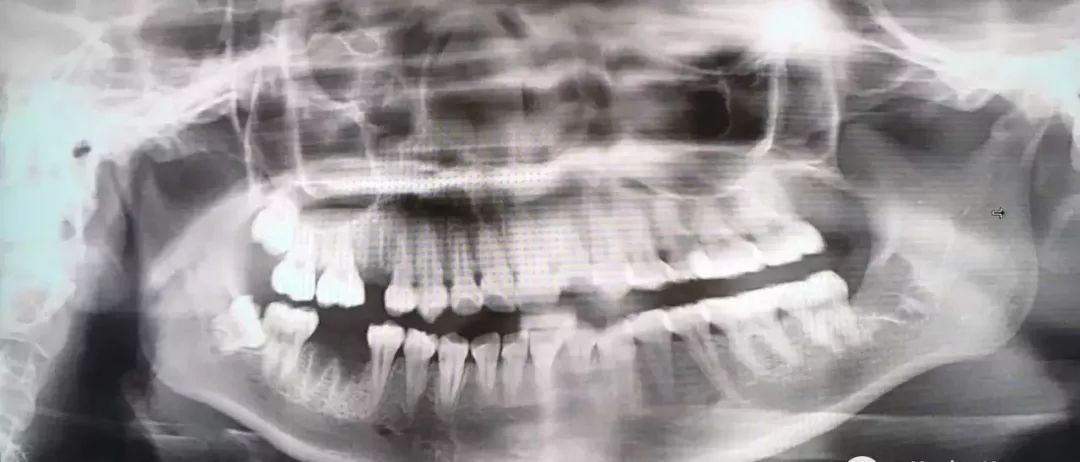 拔智齿是怎么算收费的,拔智齿是按智齿个数收费吗