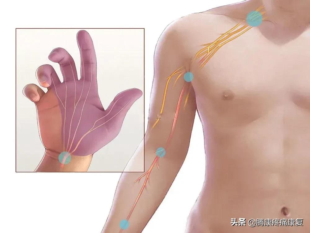 正中神经损伤治疗方法,正中神经损伤康复训练