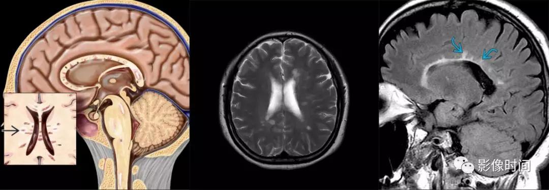 脊髓病变案例图文问诊,脊髓病变视频