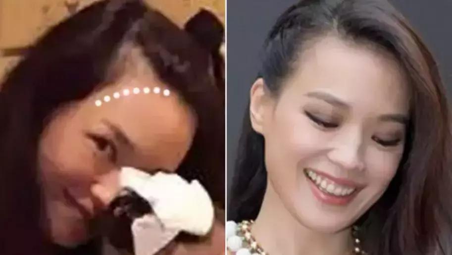 拯救发际线告别大额头,拯救发际线不走冤枉路