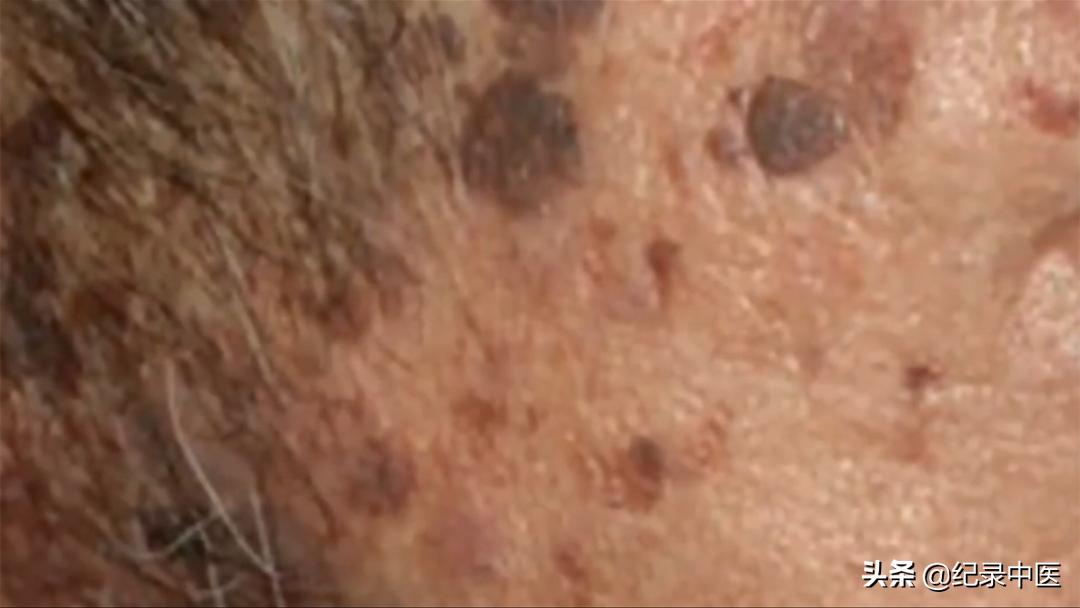 文字版|中医师带瘤生存二十载,如何用中医思维理解癌症?