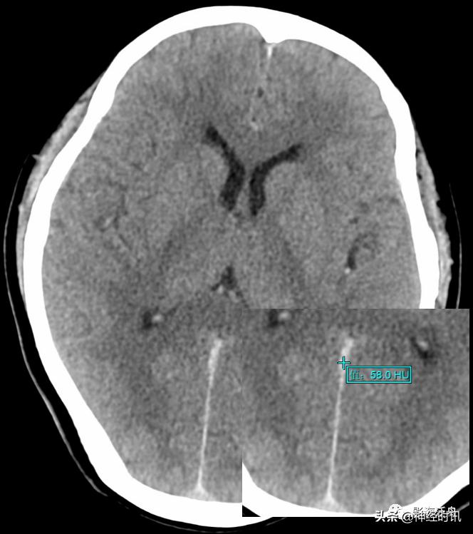 蛛血的临床表现,蛛血ct表现