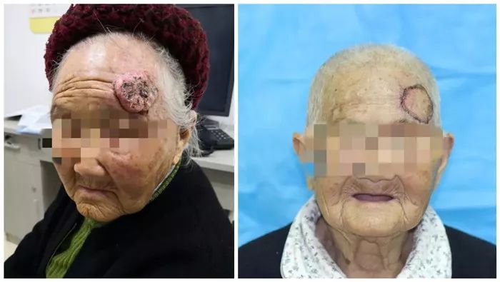 肿瘤长到6公分要紧吗,肿瘤长到拳头大怎么办